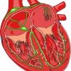 特発性（とくはつせい）拡張型心筋症（DCM：dilated cardiomyopathy)